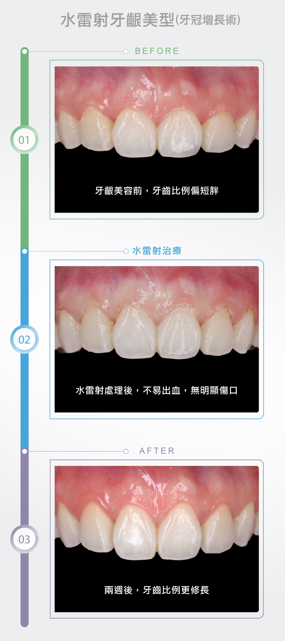 水雷射牙齦美型(牙冠增長術)3.0
